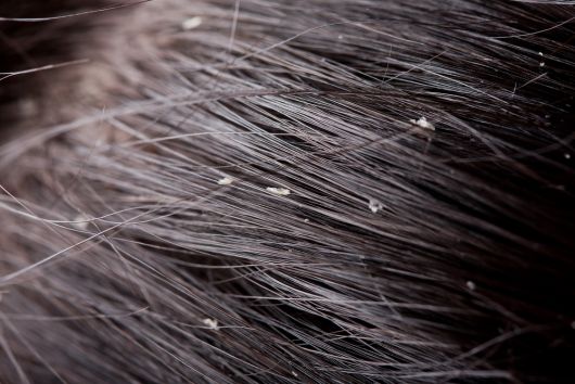 Bicarbonate de soude dans les cheveux - Avantages + 4 recettes pour rendre les fils incroyables !