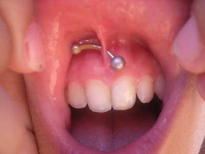 Gum Piercing: Does it hurt? Risks, precautions and tips!