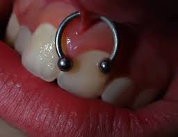 Gum Piercing: Does it hurt? Risks, precautions and tips!