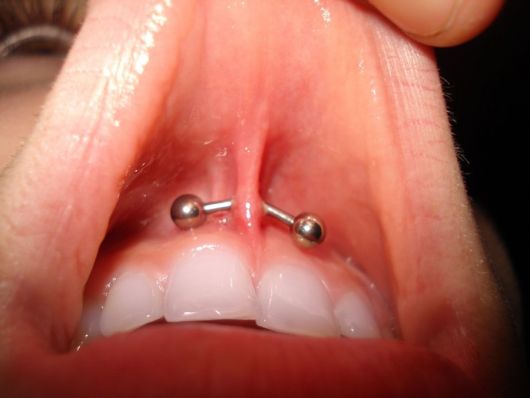 Gum Piercing: Does it hurt? Risks, precautions and tips!