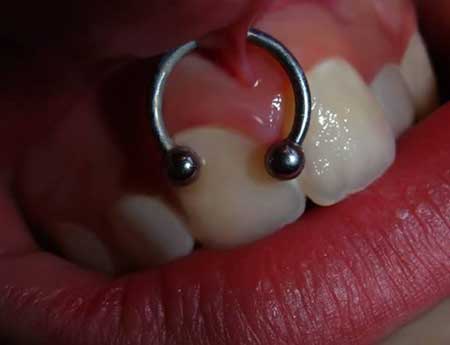 Gum Piercing: Does it hurt? Risks, precautions and tips!