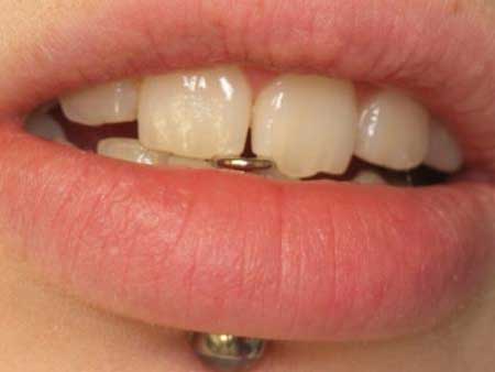 Gum Piercing: Does it hurt? Risks, precautions and tips!