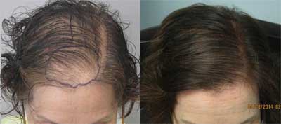 Guida completa alle protesi per capelli: cura, foto e consigli preziosi!