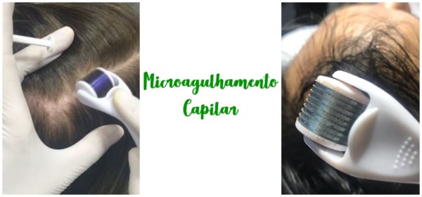 Capillary Microneedling – What is it + Results Before and After!