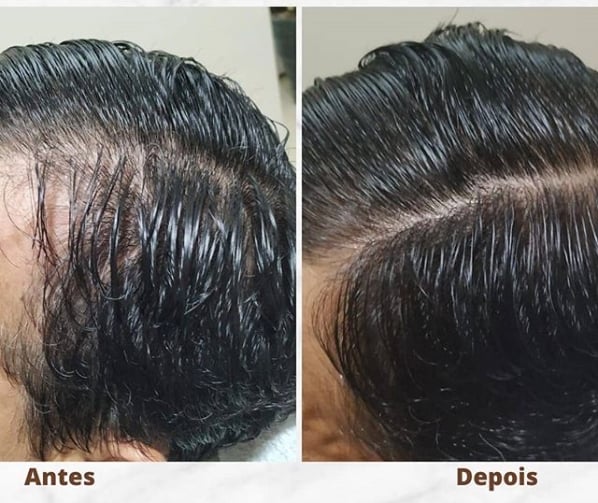 Microneedling Capilar – ¿Qué es + Resultados Antes y Después!