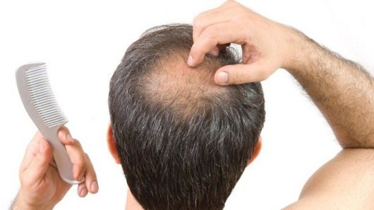 Caduta dei capelli maschile: consigli e soluzioni per combatterla!