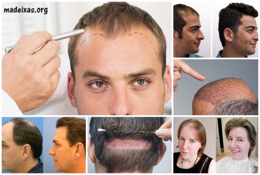 Hair Implant / Hair Transplant – What it is, Tips & Complete Guide!