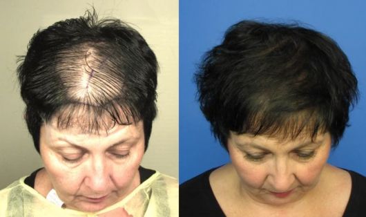 Implant capillaire / Greffe de cheveux - Qu'est-ce que c'est, conseils et guide complet !