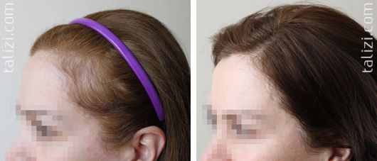 Implant capillaire / Greffe de cheveux - Qu'est-ce que c'est, conseils et guide complet !