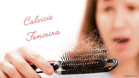 Female Pattern Baldness: Causes, Tips to Conceal It and Treatments!