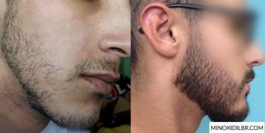 Bald Beard – 5 Efficient Solutions, Tips & How to Disguise!