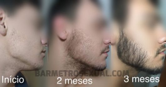 Bald Beard – 5 Efficient Solutions, Tips & How to Disguise!