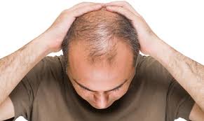 Male Pattern Baldness – Causes, Treatments & Surefire Tips!